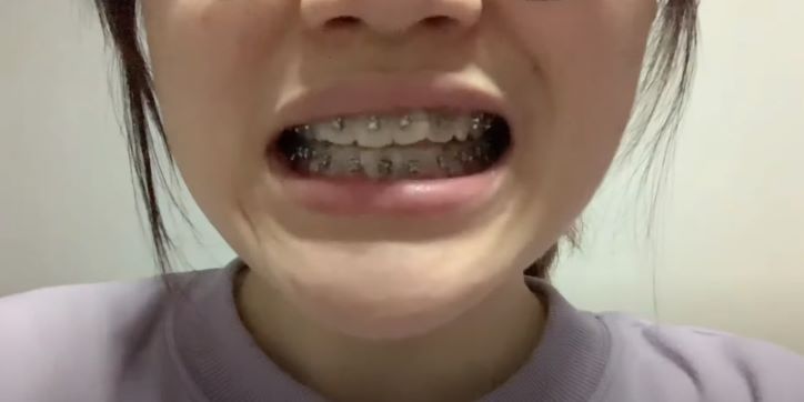 Bite blocks for braces