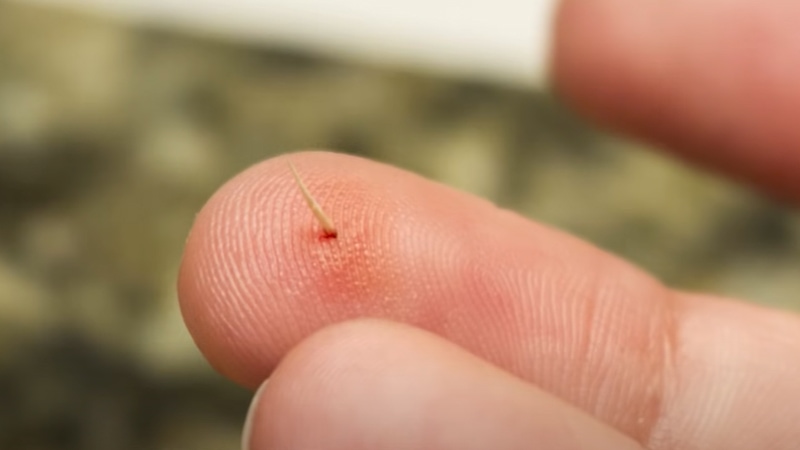 Tips When Getting Metal Shavings Out Of Skin